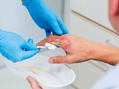 معاون آموزشی جهاد دانشگاهی گیلان: دوره آموزشی مدیریت زخم در استان برگزار می‌شود